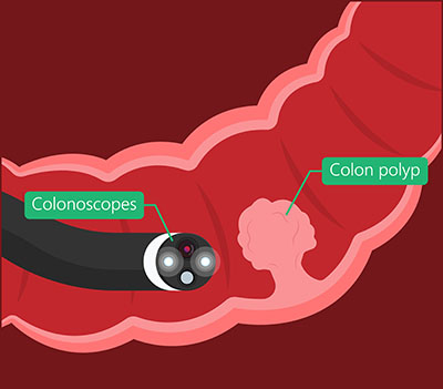 colon polyp Dr Thania Kahn Colonoscopy