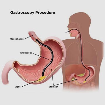 gastroscopy procedure Dr Thania Kahn Home