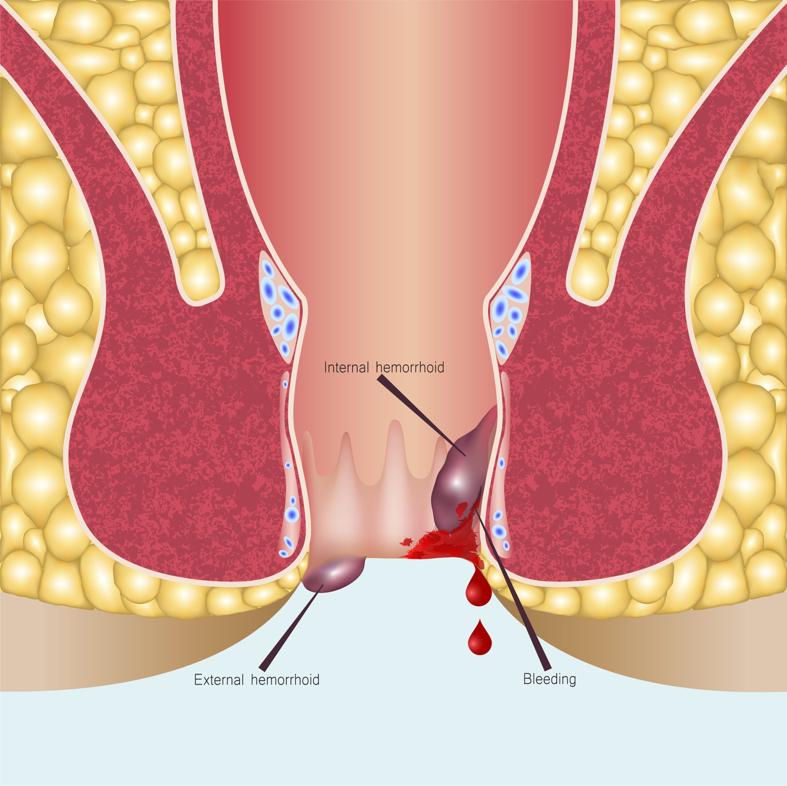 Rectal Bleeding