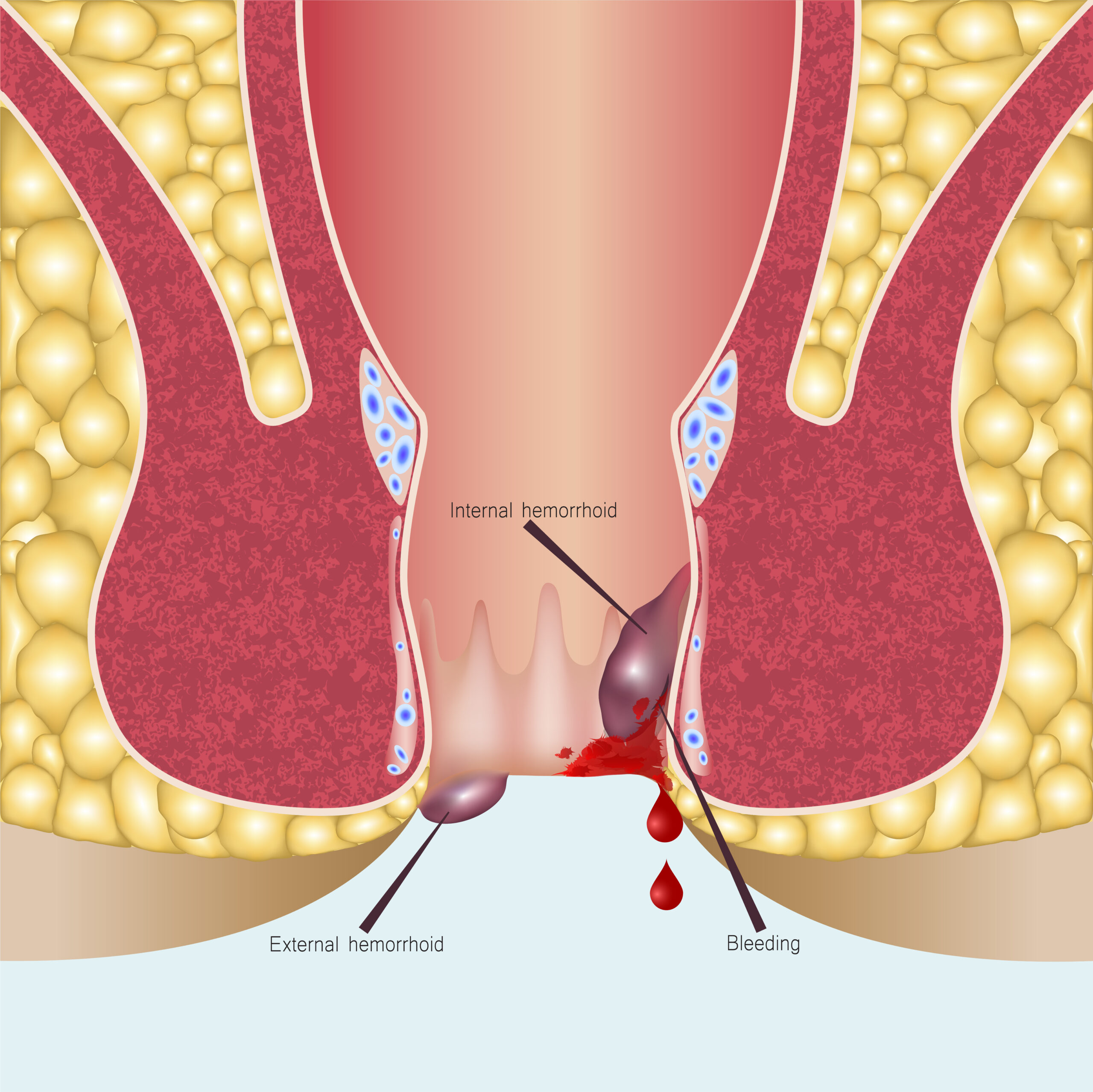 Rectal Bleeding